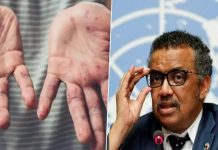 মাংকিপক্স: ৭৫ দেশে ১৬ হাজার আক্রান্ত