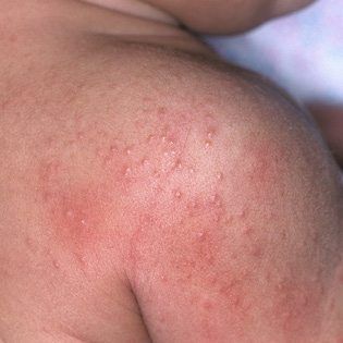Heat-Rash-baby-skin-disorders-article